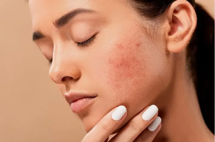 Ways to Get Rid of Acne Naturally and Effectively for Healthy and Clean Skin